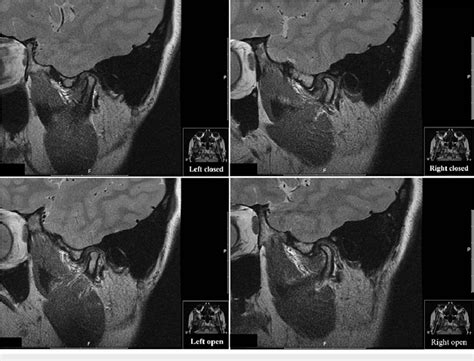 magnetic resonance imaging   left   tmjtemporal fossa
