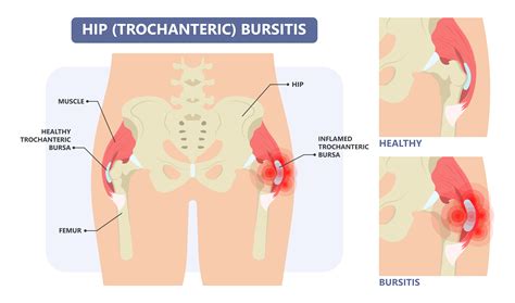 Trochanteric Bursitis Trochanteric Bursitis Treatment | Beverly Hills,