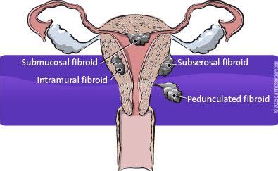 Myomectomy This Surgical Procedure Removes Problematic Fibroids From