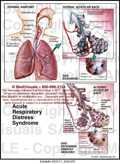 Acute Respiratory Distress Syndrome Medical Illustration