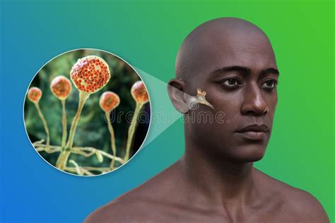 Mucormycosis Of The Middle Ear 3d Illustration Stock Illustration