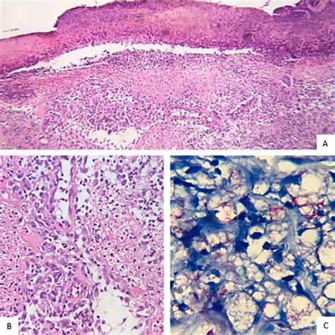 Erythema Nodosum Histology
