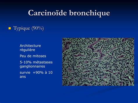 Ppt Cryotherapie Dans Le Cancer Bronchique Powerpoint Presentation