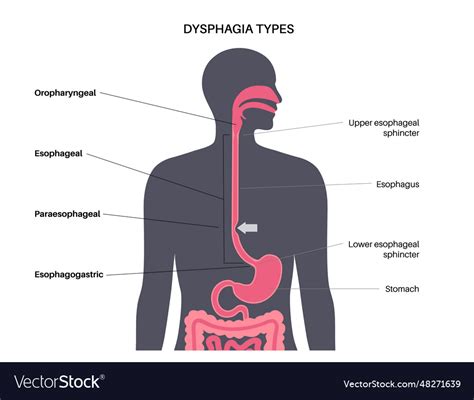 Dysphagia Medical Poster Royalty Free Vector Image