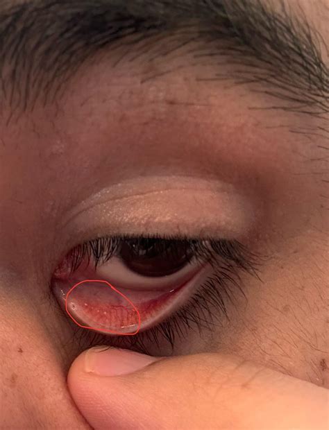 White spots behind left bottom eyelid : r/Dryeyes
