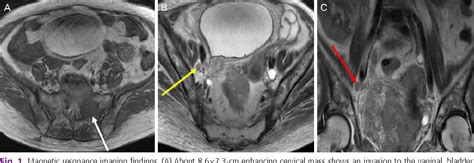 Figure From Primary Malignant Melanoma Of Cervix And Vagina