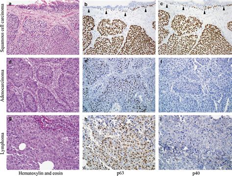 P40 Δnp63 Is Superior To P63 For The Diagnosis Of Pulmonary Squamous