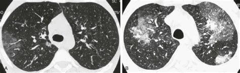 Eosinophilic Lung Diseases Thoracic Key