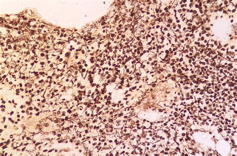 An Increase In Fibrosis Highlighted By Reticulin Stain 100x Objective