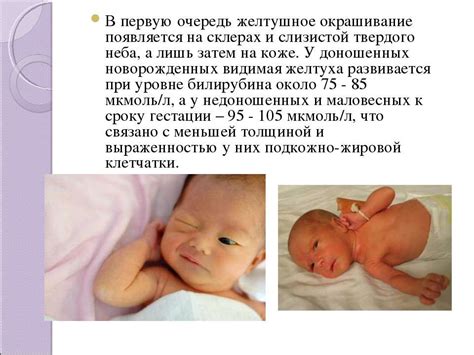 Как выходит билирубин у новорожденных из организма: Как понизить ...
