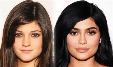 Kylie Jenner Before and After Plastic Surgery - MAYCLINIK