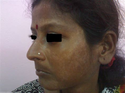 global skin atlas diagnosis detail