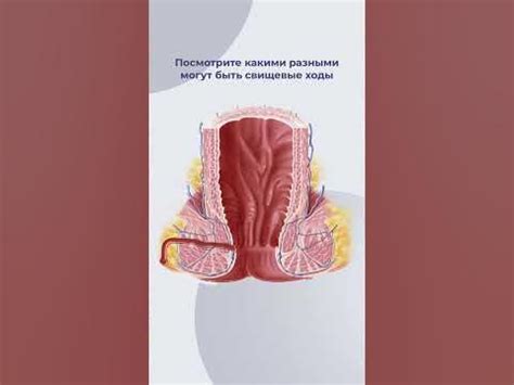 Свищи прямой кишки - YouTube