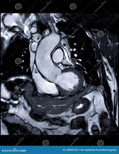 Mri Heart Or Cardiac Mri Magnetic Resonance Imaging Of Heart In Short Axis View Showing Cross