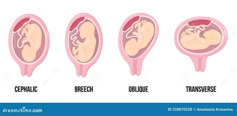 Different Wrong Baby Positions in Uterus during Pregnancy. Cephalic, Breech, Transverse, Oblique ...