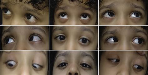 Pattern Strabismus In Consecutive Esodeviation After Bilateral Lateral