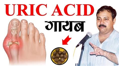 Uric Acid Ko Thik Kaise Kare By Rajiv Dixit Ji Uric Acid Treatments In Hindi Swarnim Bharat