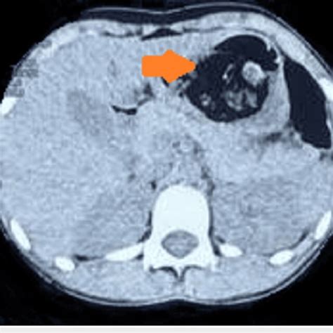 Cect Abdomen Showing A Heterogenous Irregular Mass In The Stomach Download Scientific Diagram