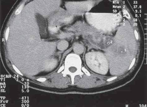 Radiografia Do T Rax Incid Ncia P Stero Anterior N O Se Evidenciam