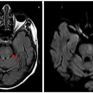cerebral magnetic resonance  ischaemic stroke  pons  axial