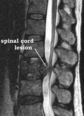 Spinal Cord Syndrome