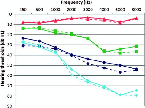 Mean Pure Tone Thresholds For The Left Dashed Line And Right Ear