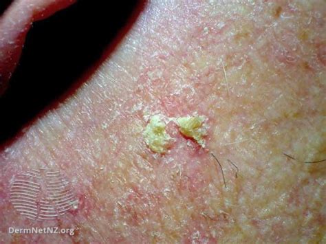 20 Common Skin Lesions And How To Spot Them