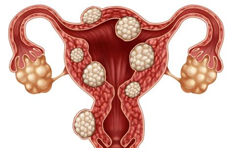 Fibromas Uterinos Causas Síntomas Tratamiento Y Prevención Remedios Caseros