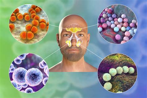 Purulent Inflammation Of Frontal And Maxillary Sinuses In A Man And