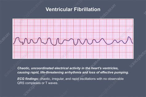 ECG in ventricular fibrillation, illustration - Stock Image - F042/5178 ...