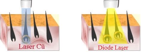 TRIỆT LÔNG VÙNG BIKINI BÍ KÍP TỰ TI CHO NÀNG THÊM CÁ TÍNH