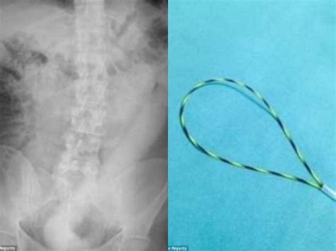 Mi Fa Male La Pancia Ma Si Era Infilato Un Dildo Di Cm Salvato