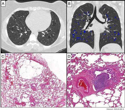 Diffuse Cystic Lung Disease As The Primary Tomographic Manifestation Of