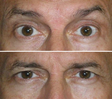 Botox Customization And The Droopy Brow