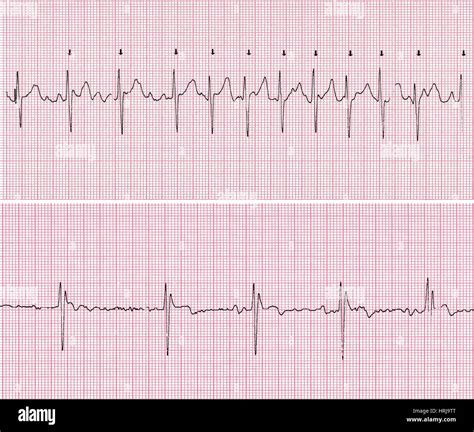 Fibrillation auriculaire ecg Banque de photographies et dimages à