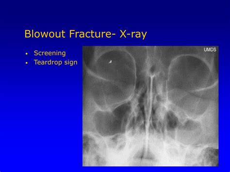 Blow Out Fracture X Ray