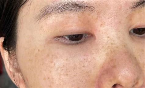 【皮肤科祛斑方法】脸上开始长色斑晒斑雀斑黄褐斑是什么原因？长斑要怎么恢复？医学硕士教你3招安全有效祛斑，怎么祛斑1篇搞定！ 知乎