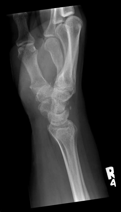 avulsion fracture betapikol