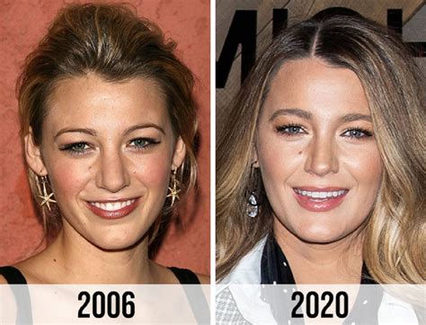 Blake Lively Nose Job: Plastic Surgery Before And After 2023