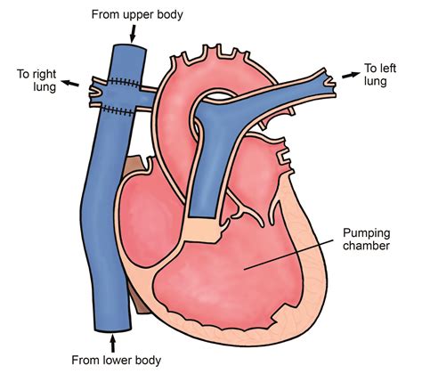 Fontan Circulation Leeds Teaching Hospitals Nhs Trust