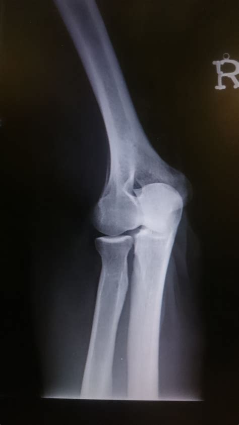 Posterior Impingement of Elbow | Sport Med School