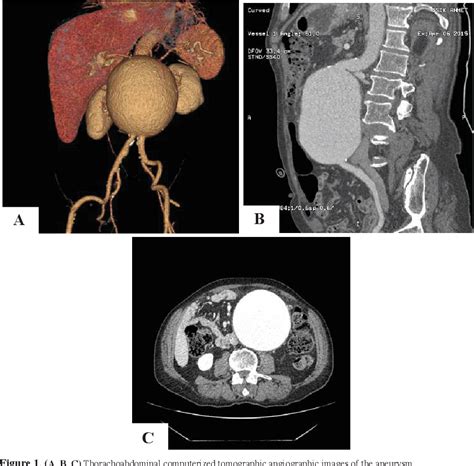 Figure 1 From Giant Abdominal Aortic Aneurysm A Wondrous Image With