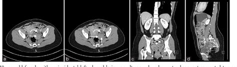 Figure 2 From Radiographic Features Of A Benign Mixed Brenner Tumor And