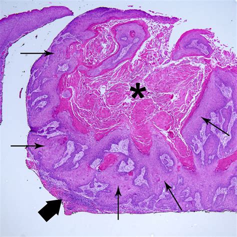 Ceratoacantoma Palpebra