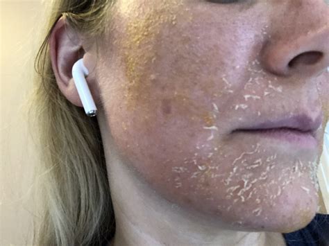 Dermamelan Peel For Melasma Patient Journey Lumiere Clinic