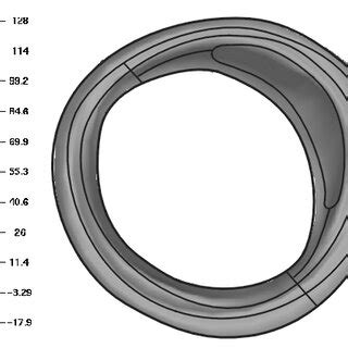 reconstruction   diseased artery   exploded view