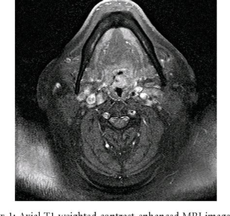 Figure 1 From Extramedullary Plasmacytoma Of The Tonsil Semantic Scholar