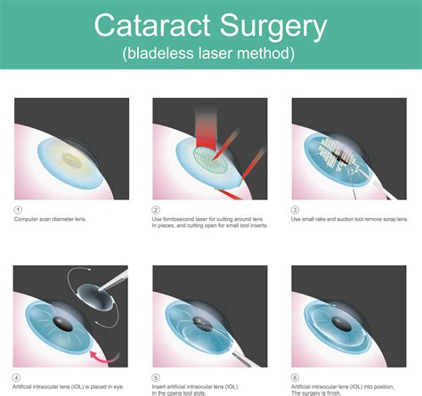 Procedure For Cataract Surgery From Beginning