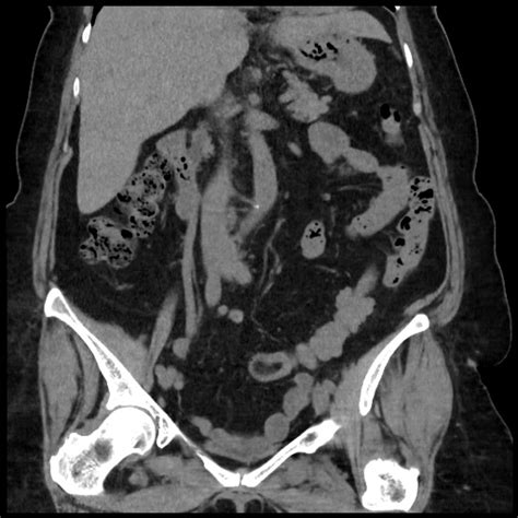 Distal Colocolic Intussusception Due To Lipoma Epiploic Appendagitis