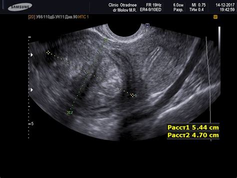 Myoma of the uterus (FIGO-6) Ultrasound Sonography, Sonographer ...